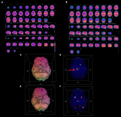 Longitudinal Single Photon Emission Computed Tomography Neuroimaging as an Indication of Improvement in Psychiatric Disorders in a Community Psychiatric Practice